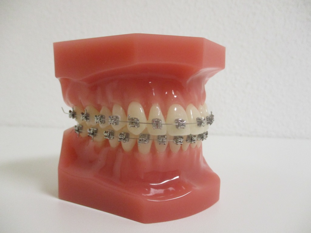 feste Zahnspange mit Brackets