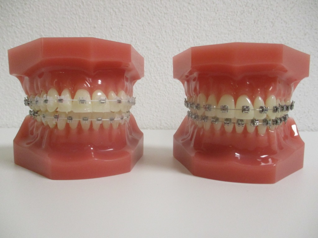 Zahnspange mit selbstligierenden Brackets